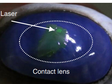 contact lens laser